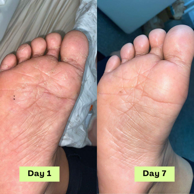 Loravey® Antimykotische Relief-Seifenstück