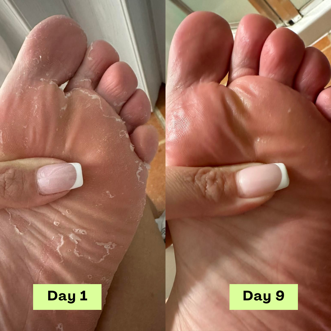 Loravey® Antimykotische Relief-Seifenstück