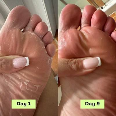 Loravey® Antimykotische Relief-Seifenstück