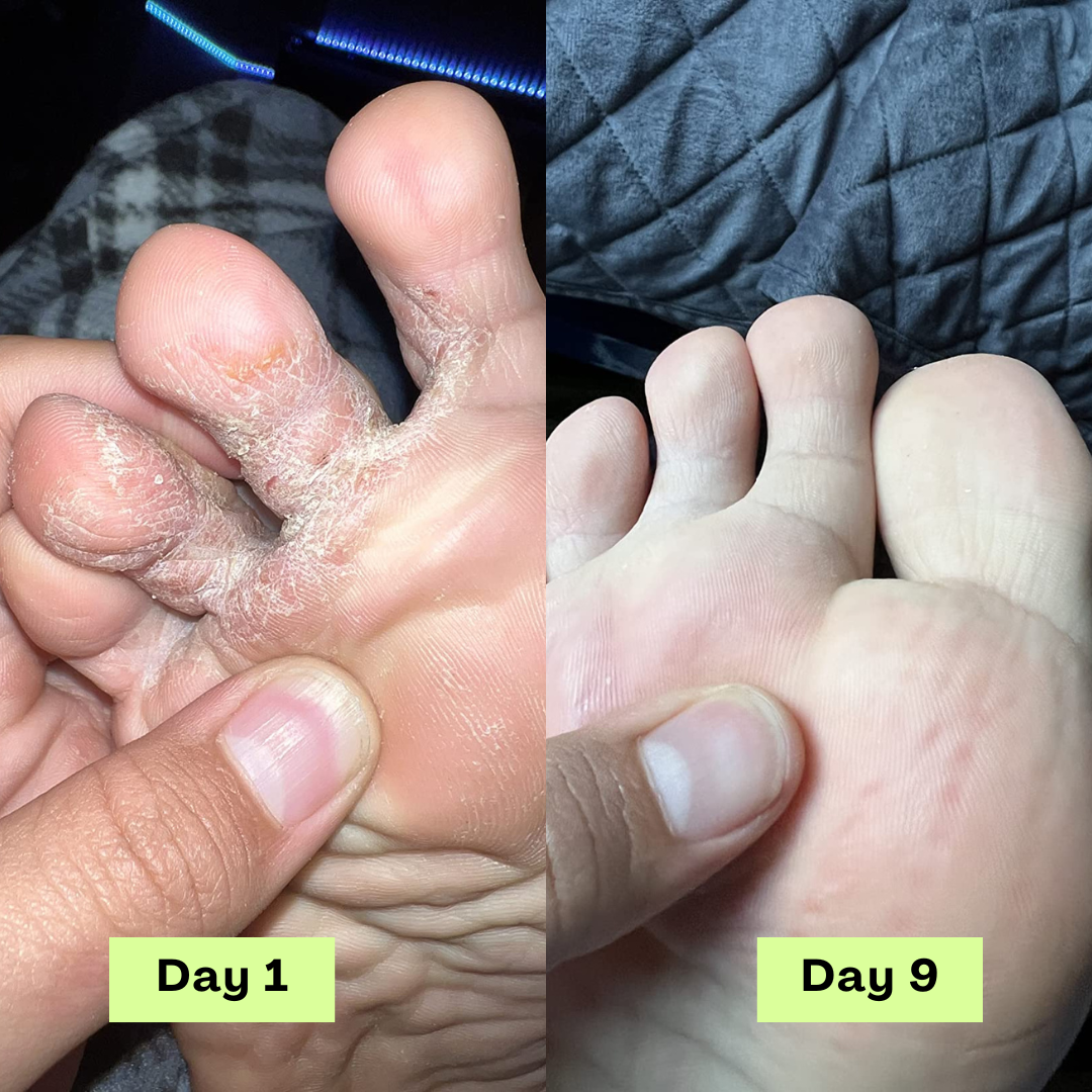 Loravey® Antimykotische Relief-Seifenstück